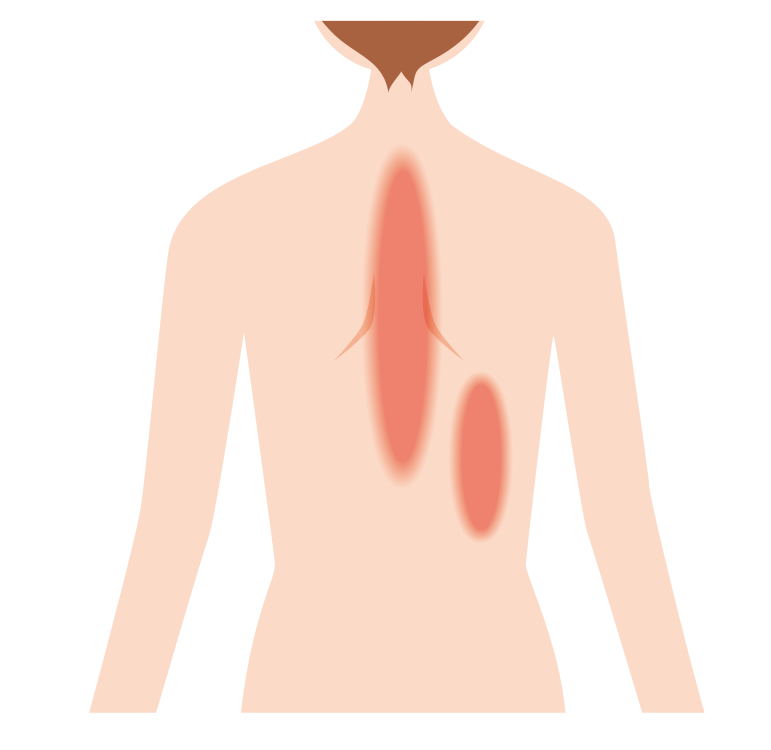 肋間神経痛イメージ